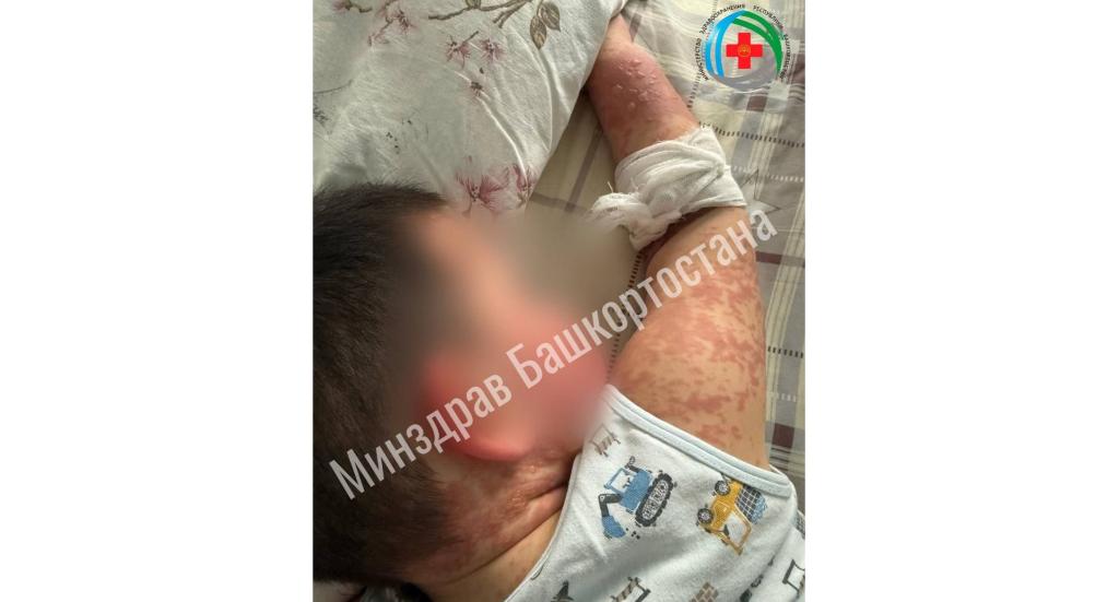В Уфе врачи спасли малыша с синдромом «ошпаренной кожи»
