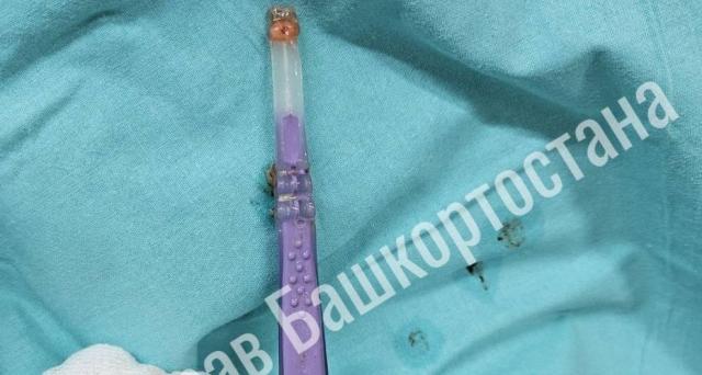 В Уфе врачи извлекли из пищевода пациента зубную щетку