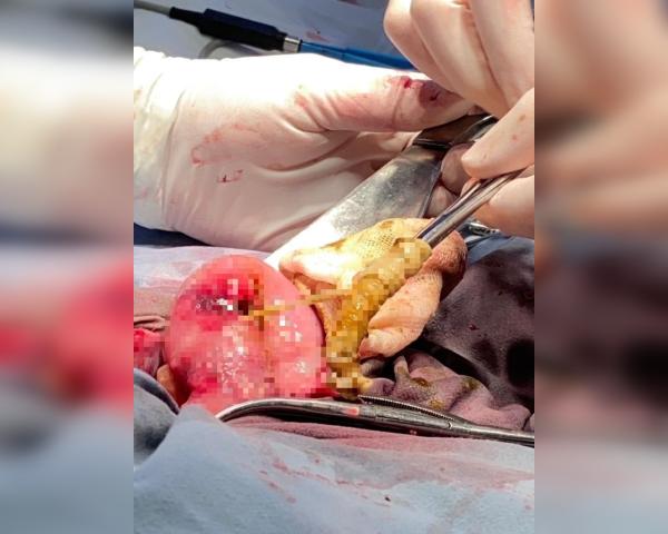 В Уфе из кишечника пациента вытащили червя длиной 120 см