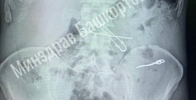 В Уфе врачи спасли пациента, проглотившего скрепки и булавку