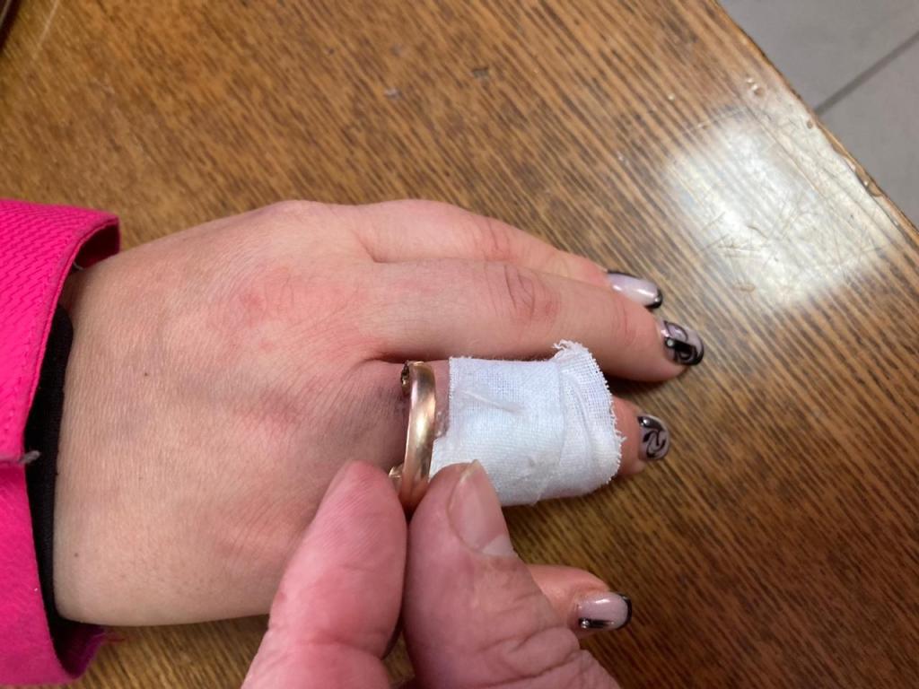 Жительнице Башкирии пришлось вызывать спасателей, чтобы снять кольцо с пальца