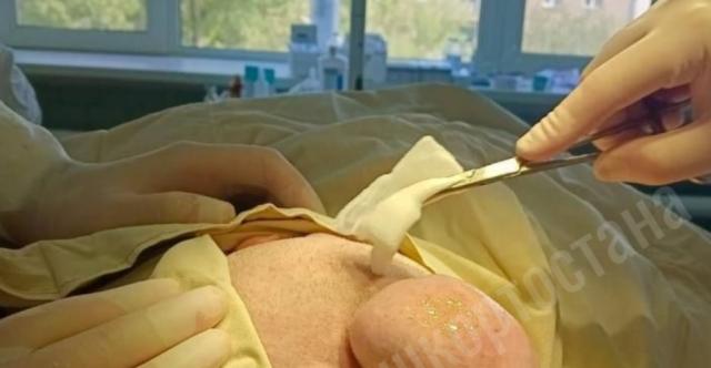 Врачи в Башкирии удалили огромную кисту на голове пенсионерки