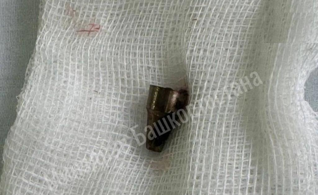 В Уфе врачи достали из уха женщины наконечник ручки