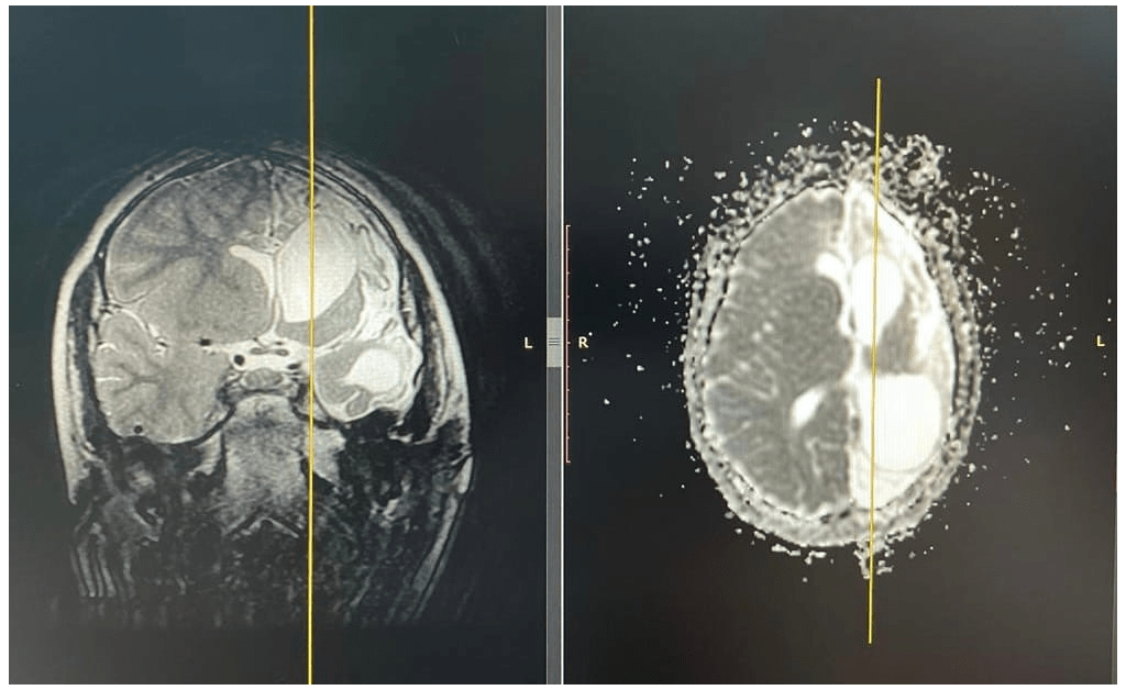 В Уфе пятилетнему ребенку провели редкую операцию