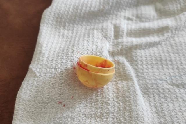 В Башкирии врачи спасли жизнь ребенка, проглотившего футляр от шоколадного яйца