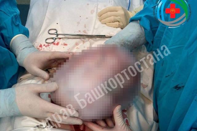 Врачи в Уфе удалили 67-летней пациентке огромную опухоль