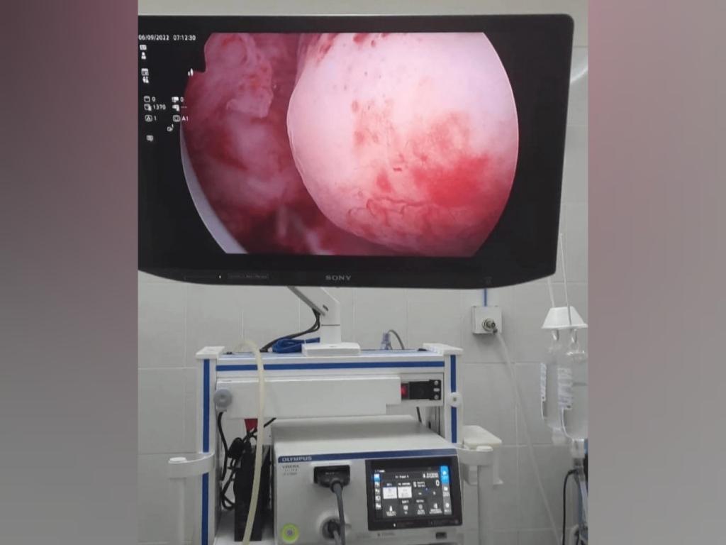 В Уфе врачи удалили женщине огромную опухоль